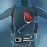 Ventricular Assist Device