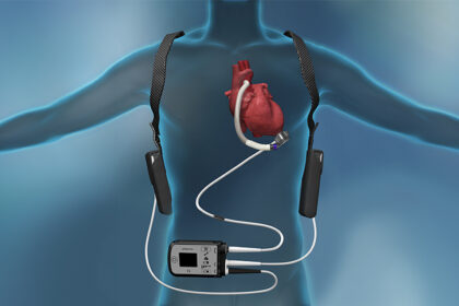 Ventricular Assist Device