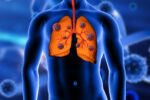 Tuberculosis Therapeutics Market
