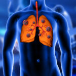 Tuberculosis Therapeutics Market